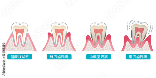 歯周病の進行　医療
