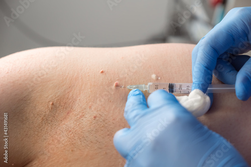 Surgeon in gloves gives injection of local anesthesia to patient before laser removing of moles or papillomas, closeup armpit. One day surgery concept. Removing nevus or birthmark. Cosmetic treatment.