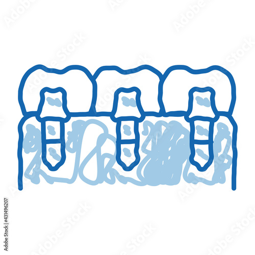Dental Teeth Implants Biomaterial doodle icon hand drawn illustration