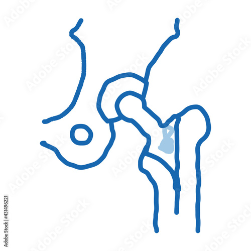 Hip Implant Replacement Biomaterial doodle icon hand drawn illustration
