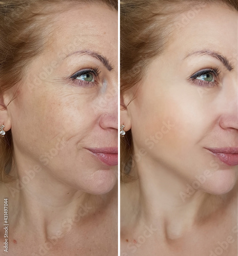 woman eyes wrinkles before and after treatment photo