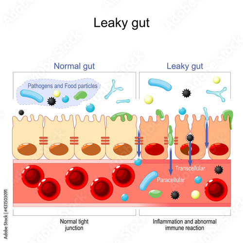 leaky gut