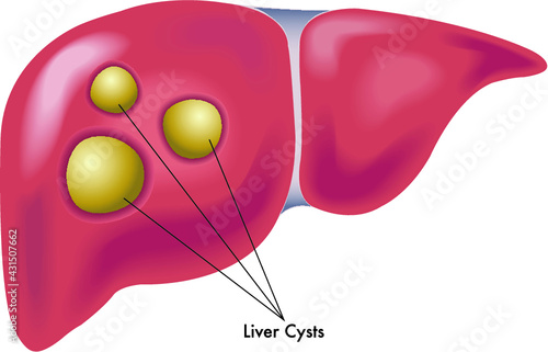 Medical illustration shows a liver with various cysts.