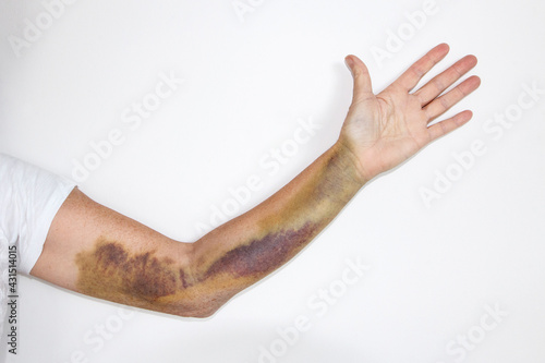 Intense bruising from a dislocated elbow joint, break of the olecranon bone and ligament damage on a mature woman. The bruise is approximately three weeks old and starting to recede. photo