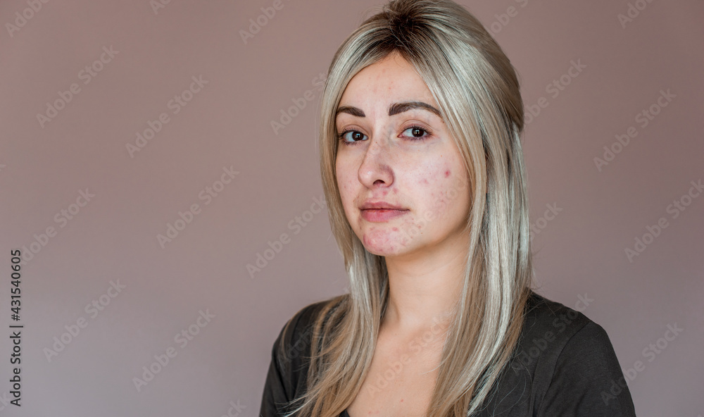 Life with acne, Problem skin prone to rashes and acne, scars, concept of healthy skin, dermatology and cosmetology Life with acne, Problem skin prone to rashes and acne, scars, concept of healthy skin, dermatology and cosmetology