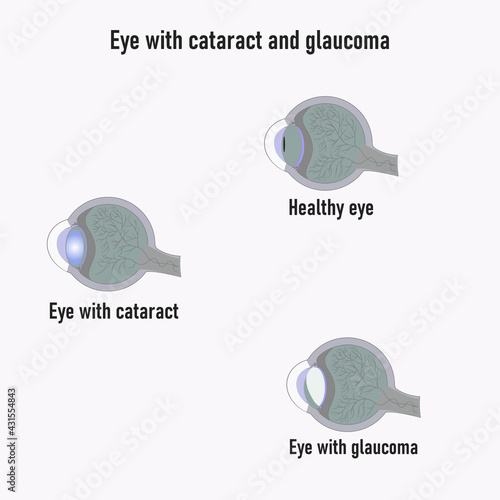 Glaucoma eye. Development of Glaucoma. The structure of the eye. Cataract. Eye vision disorder.Diagram of the eye.Symptoms of glaucoma and cataract. World glaucoma day. The anatomical structure of the