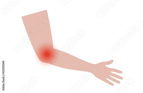 Lateral medial epicondylitis