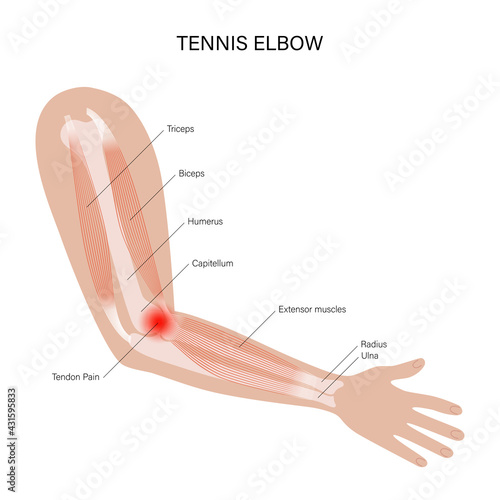 Lateral epicondylitis tennis elbow photo