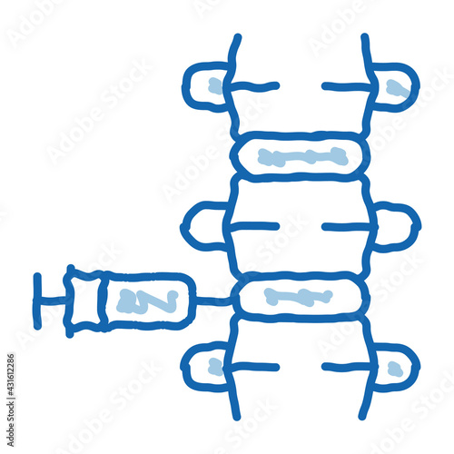 epidural spinal anesthesia doodle icon hand drawn illustration