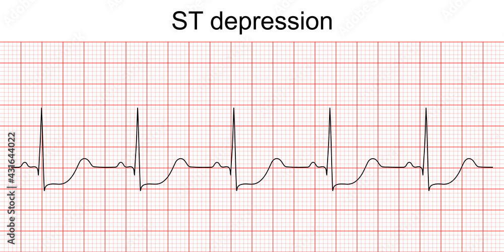 St Segment Depression