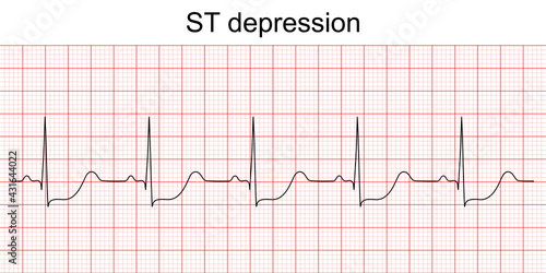 Electrocardiogram show ST segment depression pattern. Heart attack. Ischemic. Coronary artery disease. Angina pectoris. Chest pain. ECG. EKG. Medical health care.