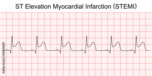 Electrocardiogram show ST elevation myocardial infarction (STEMI) pattern. Heart attack. Ischemic. Coronary artery disease. Angina pectoris. Chest pain. ECG. EKG. Medical health care. photo