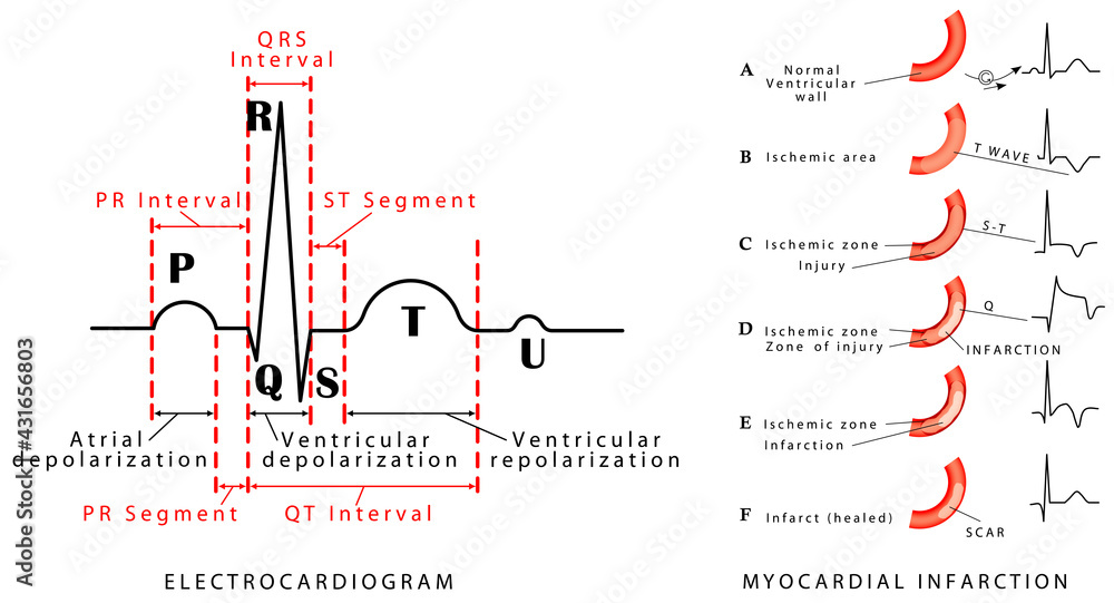 The heart cycle. Normal ECG. Myocardial infarction ECG. Wave changes