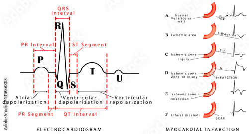 The heart cycle. Normal ECG. Myocardial infarction - ECG. Wave changes during evolution of myocardial damage. Myocardial infarction in the posterior wall and an occlusion of the circumflex artery.