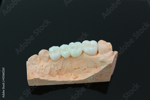 Wallpaper Mural Dental zirconia bridge with all porcelain Torontodigital.ca