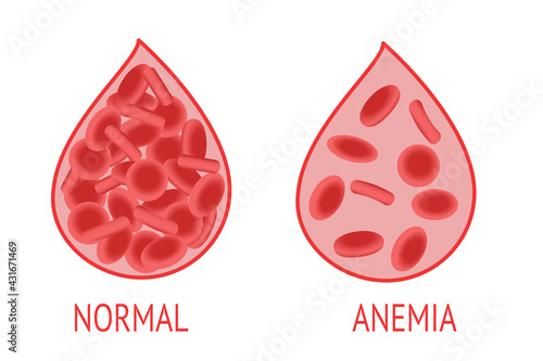 Anemia. Comparison of a drop of blood with normal and anemic blood cells. Isolated vector image on white background. Anemia concept.