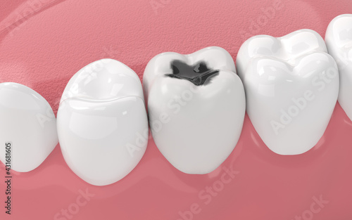 Tooth decay, unhealthy teeth, 3d rendering.