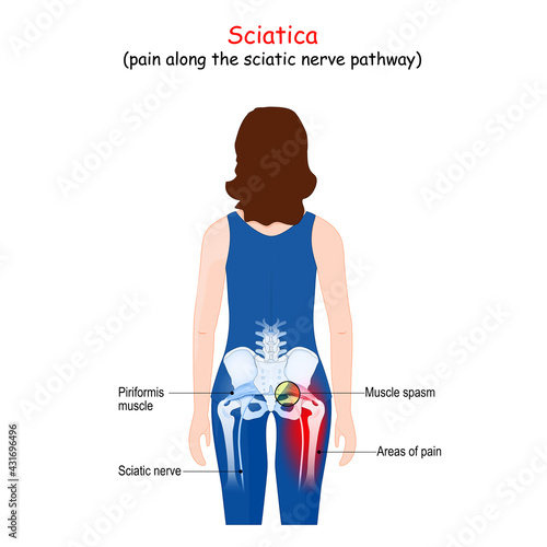 Sciatica.  Body of a patient (woman) with areas of pain from the back. Piriformis