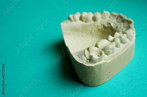 the plaster upper jaw lies on a turquoise background, side view. children's dentistry. dental treatment photo