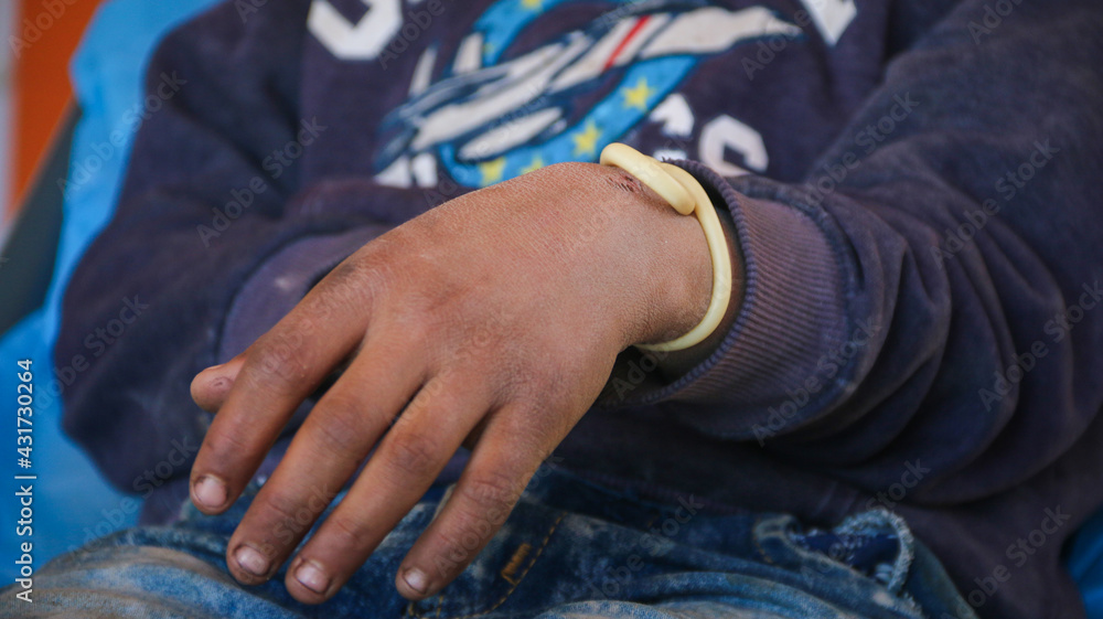 Child's hand is burned Child's hand is burned
