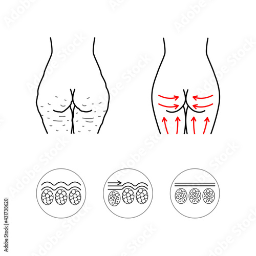Anti-cellulite icons set editable stroke