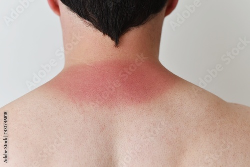 sunburned skin on the neck of a young man. Sudden transition from normal to burnt skin.