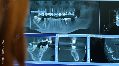 Close-up of doctor dentist looks at x-rays of the patient's jaw and teeth on the monitor, modern dentistry