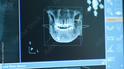 Close-up of doctor dentist looks at looks 3d model of x-rays of the patient's jaw and teeth on the monitor, modern dentistry