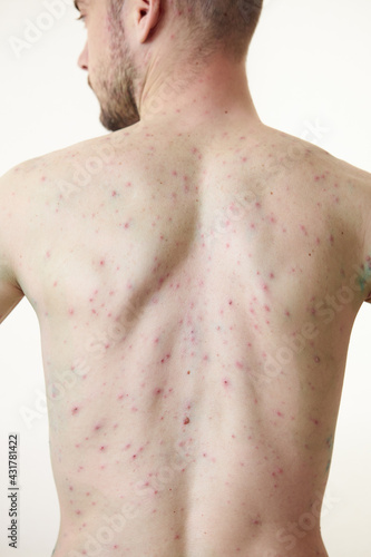 Obraz na plátně Body of adult  man have spotted, red pimple and bubble rash from chickenpox or varicella zoster virus