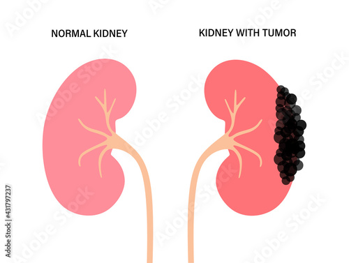 Kidney disease concept