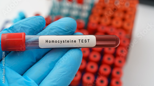 Homocysteine diagnosis for heart disease test result with blood sample in  test tube on doctor hand in medical lab Stock Photo | Adobe Stock
