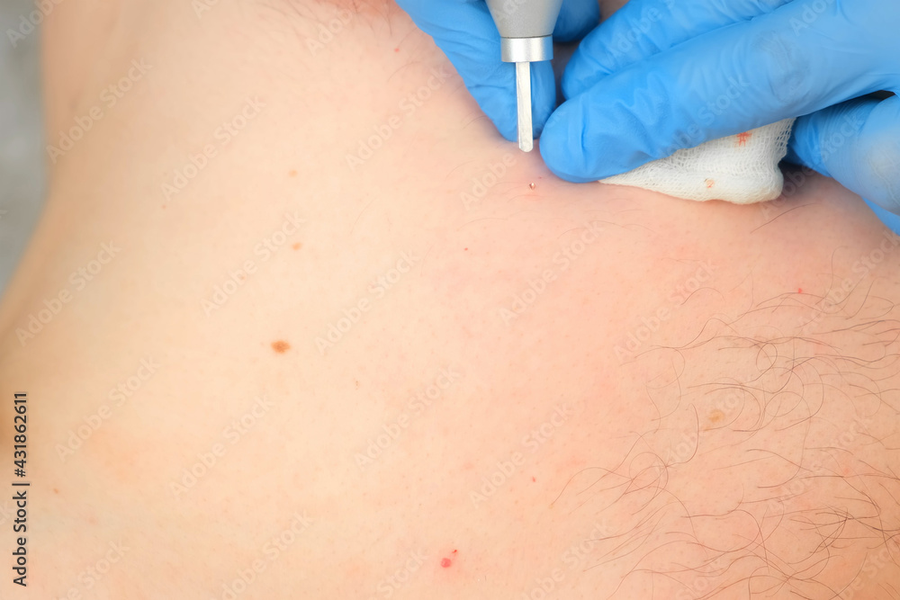Surgeon removing many small moles using laser on man's body, burning skin, closeup view. One day surgery concept. Removing papilloma or birthmark, surgical procedure. Surgeon removing many small moles using laser on man's body, burning skin, closeup view. One day surgery concept. Removing papilloma or birthmark, surgical procedure.