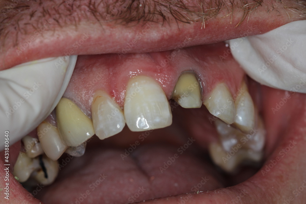 Obraz premium new teeth for the patient. new smile. match the color with the teeth. 