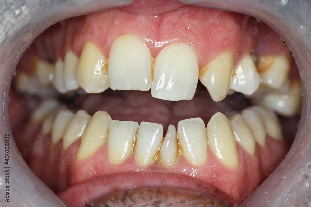 Fototapeta premium new teeth for the patient. new smile. match the color with the teeth. 