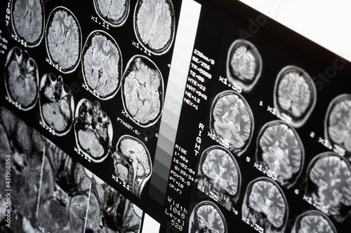 MRI of  brain of a healthy person. Magnetic resonance scan. Medical healthcare concept