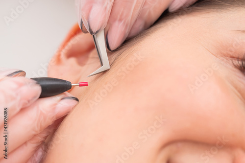 Woman on electro-epilation of the face. Hardware permanent removal of unwanted hair in the salon