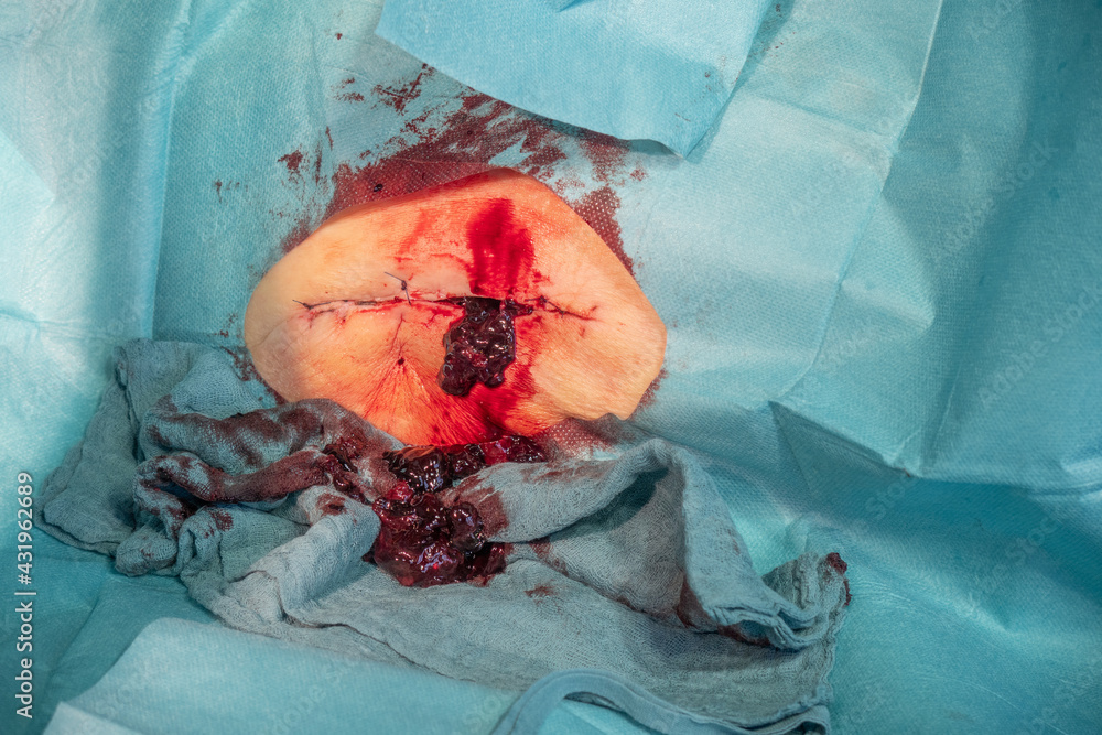 some blood leaks from a sutured wound