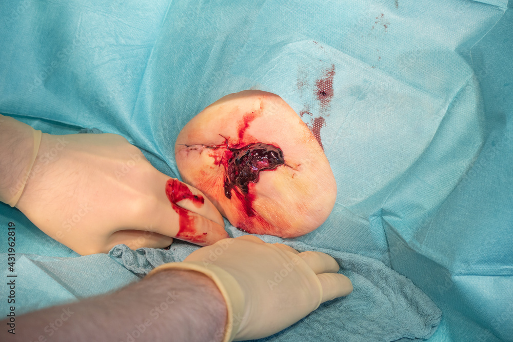 in the operating room a hematoma of a patient is operated by a doctor