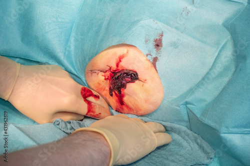 Obraz na płótnie in the operating room a hematoma of a patient is operated by a doctor w salonie