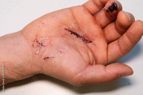 deep cut of the hand sewn up with surgical sutures. concept of traumatology and surgery in medicine