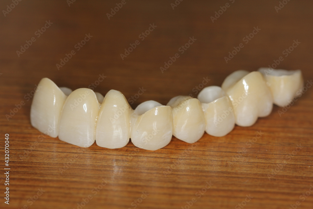 Zirconia bridge with all porcelain. smile make-over Zirconia bridge with all porcelain. smile make-over