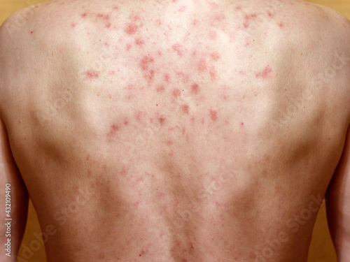 Dermatitis on skin of a man`s back. Allergic reaction. Allergic rash on chest skin. Dermatitis. Seborrheic dermatitis