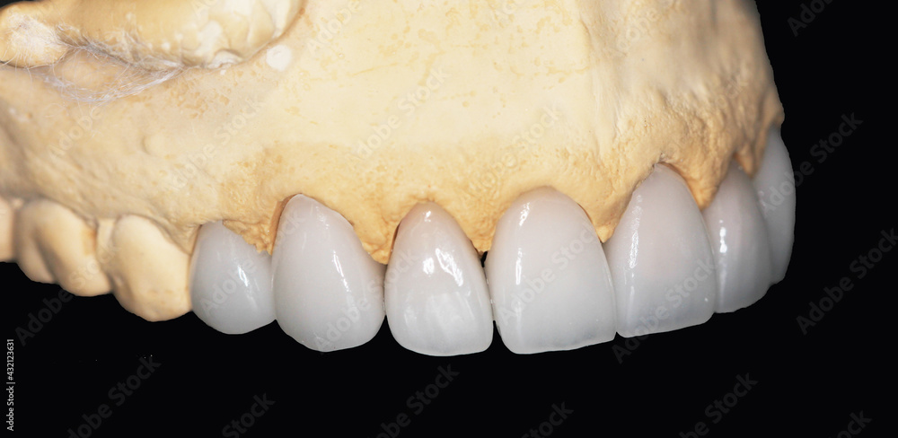 custom made wallpaper toronto digitalDental zirconia crowns in the plaster model