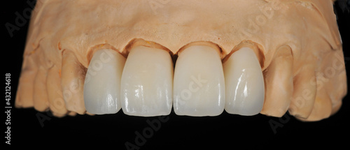Dental zirconia crowns in the plaster model