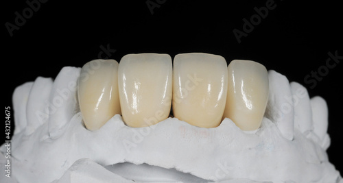 Dental zirconia crowns in the plaster model photo