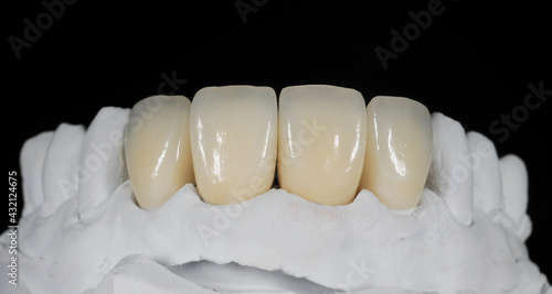 Dental zirconia crowns in the plaster model