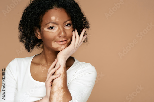 Young woman demonstrates her skin spots on her hands and face with vitiligo photo