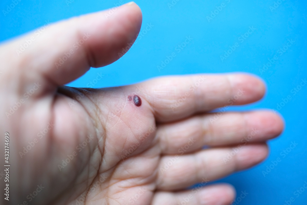 female hand with subcutaneous hemorrhage on the palm, trauma from pinching the hand, medical concept female hand with subcutaneous hemorrhage on the palm, trauma from pinching the hand, medical concept