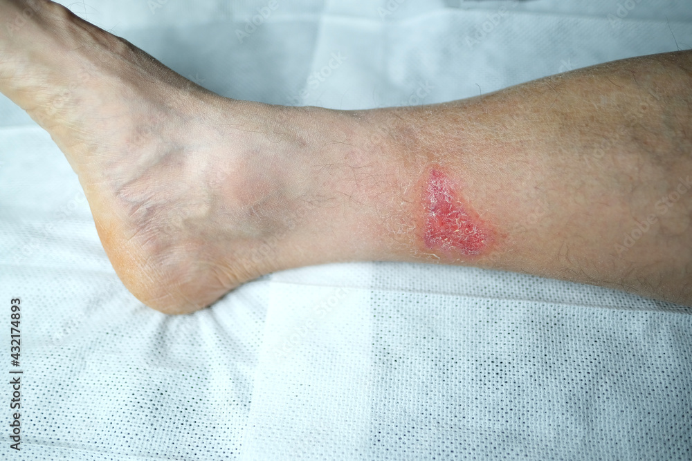 large healing wound from a severe burn on the leg of an adult male patient, redness, scarring of the skin, the concept of medical care, human tissue regeneration large healing wound from a severe burn on the leg of an adult male patient, redness, scarring of the skin, the concept of medical care, human tissue regeneration