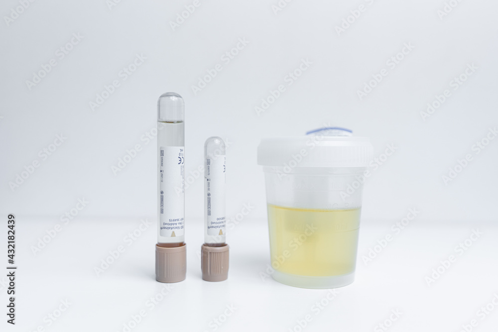 Espoo. Finland. 06 May 2021 Urine tests in medical tubes